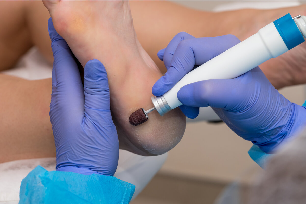 Неправильная обувь и плоскостопие – главные враги здоровой кожи на стопах | фото предоставлены клиникой 