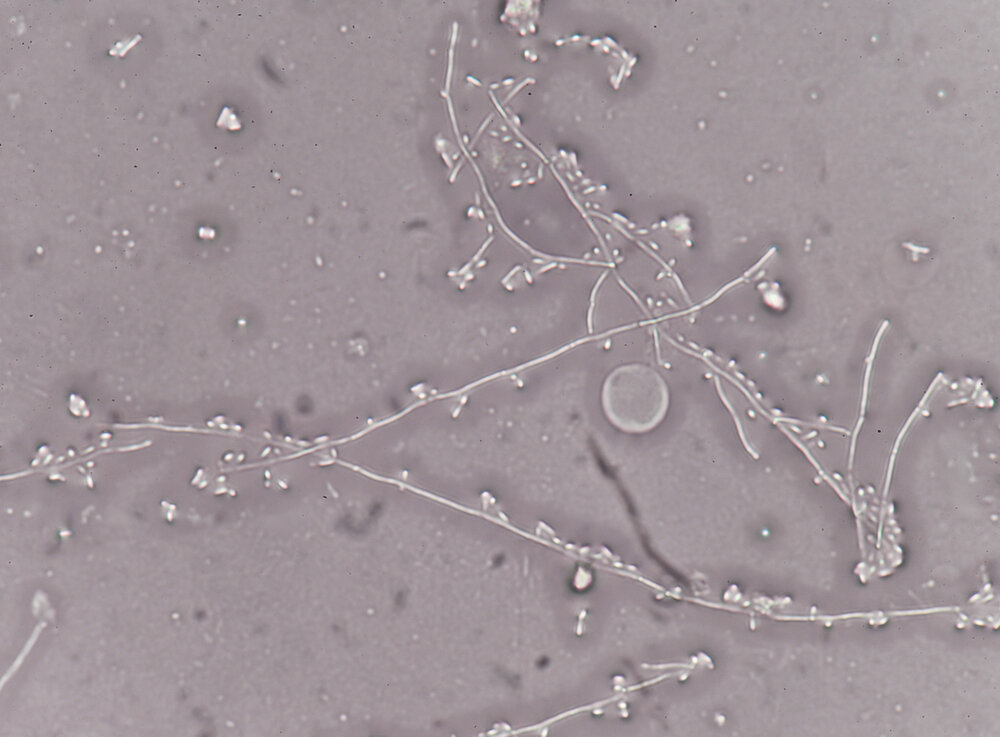 По утверждениям бывшего онколога Туллио Симончини, именно эти грибки вызывают рак.