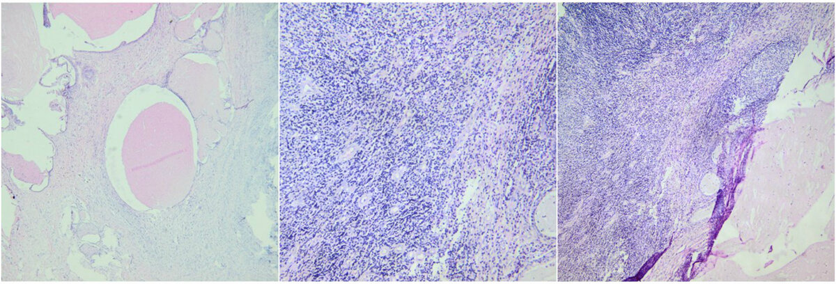 Морфологическая картина характерная для гнойно-некротического воспалительного процесса