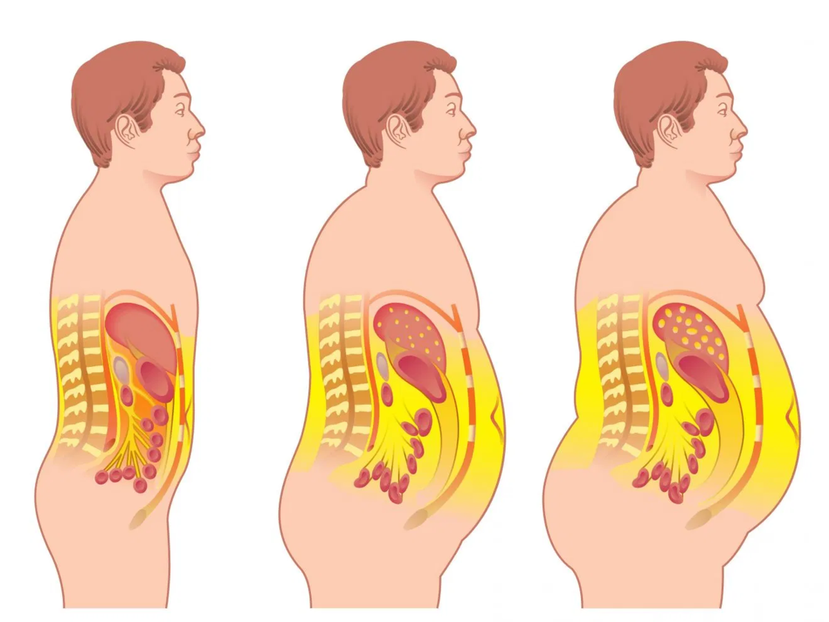 Растет живот у мужчин после 40. Висцеральный жир анатомия. Висцеральное ожирение.