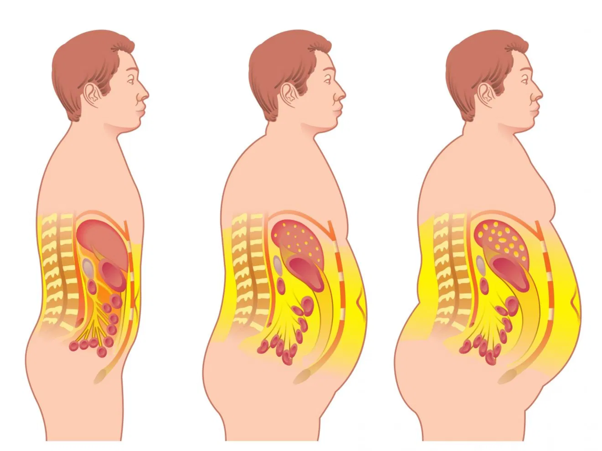 Толстый под жиром. Висцеральный жир анатомия. Висцеральное ожирение.