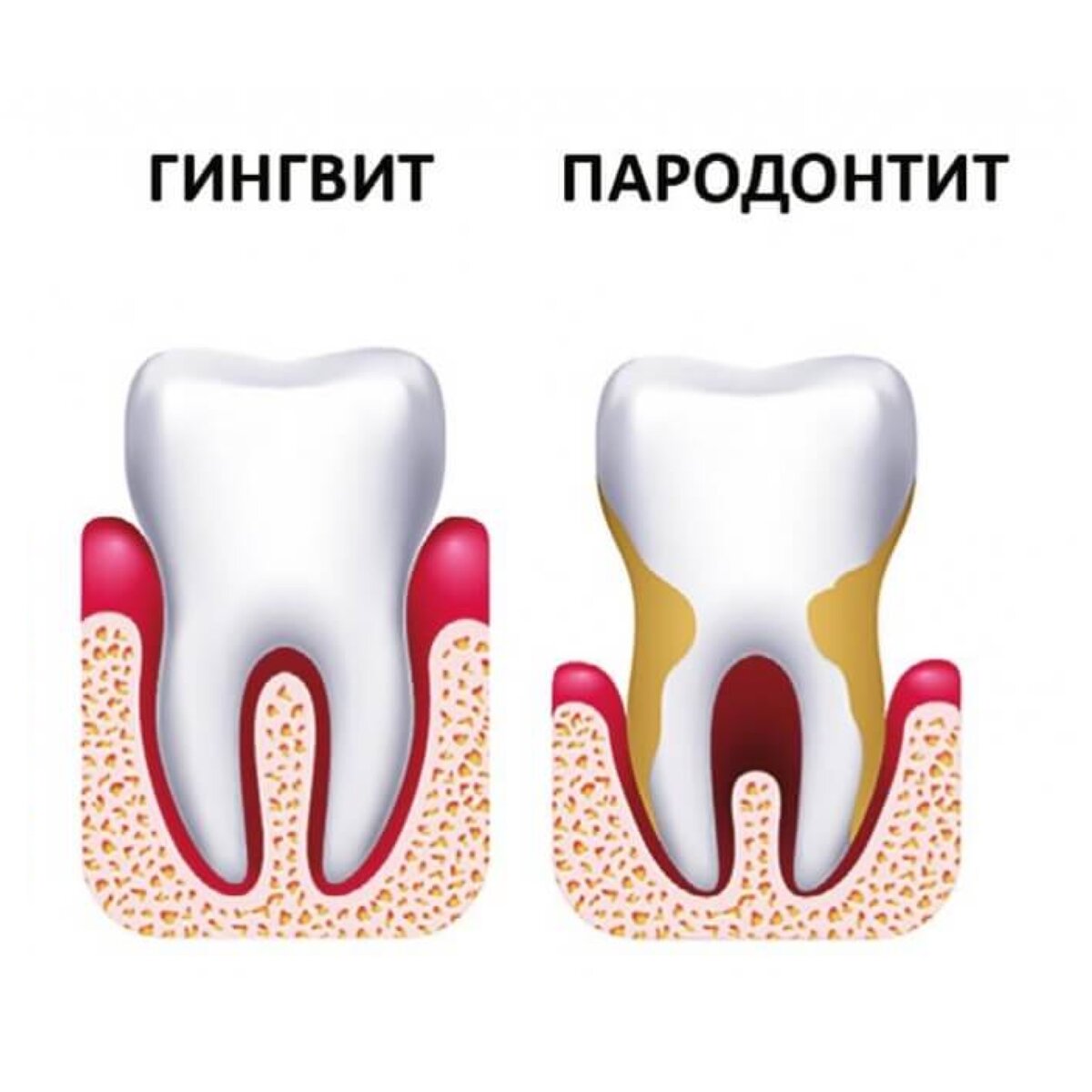 Болезни зубов картинки