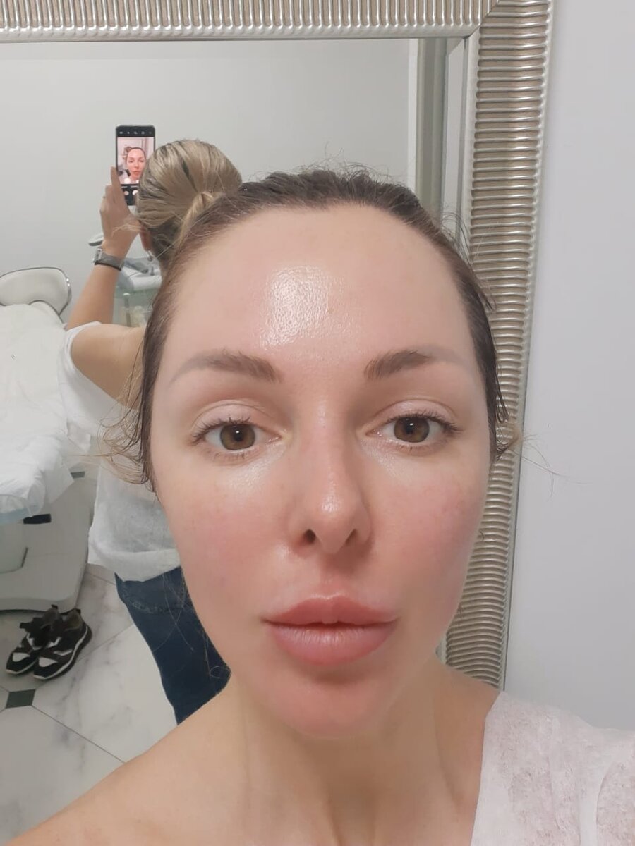Наша пациентка поделилась фото результатом после  HydraFacial MD,имеются противопоказания, требуется консультация специалиста. 