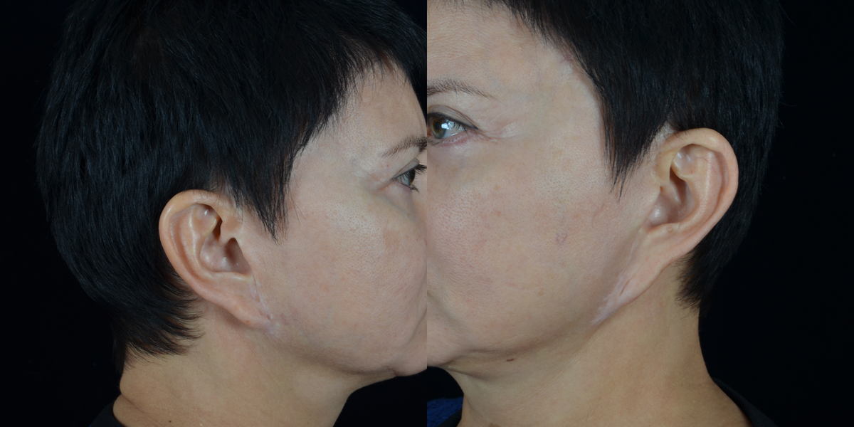 Осложнения после подтяжки лица и  некрасивые рубцы, фото с сайта хирурга Д.Р.Гришкяна, имеются противопоказания, требуется консультация специалиста. 