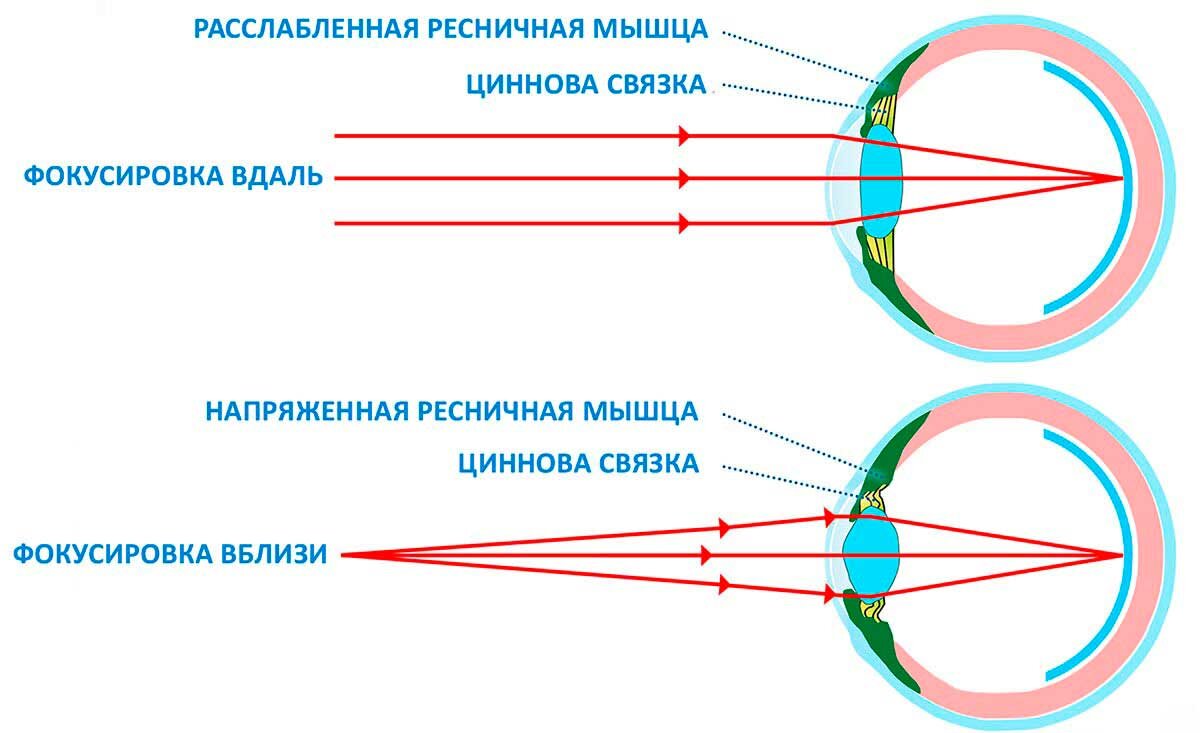 Возможно ли восстановить зрение при близорукости?