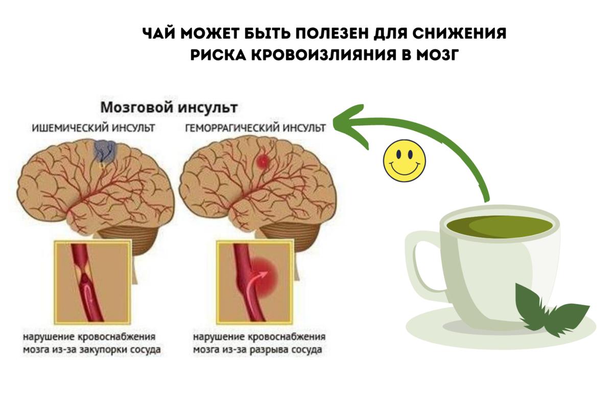 Последствия после обширного инсульта. Кровоизлияние в мозг геморрагический инсульт. Кровоизлияние в мозг симптомы. Кровоизлияние в мозг осложнения.