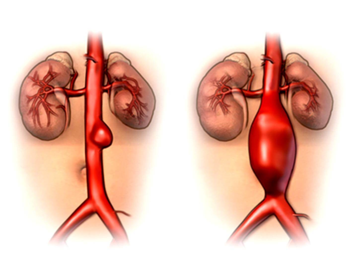 Аневризма аорты брюшной полости