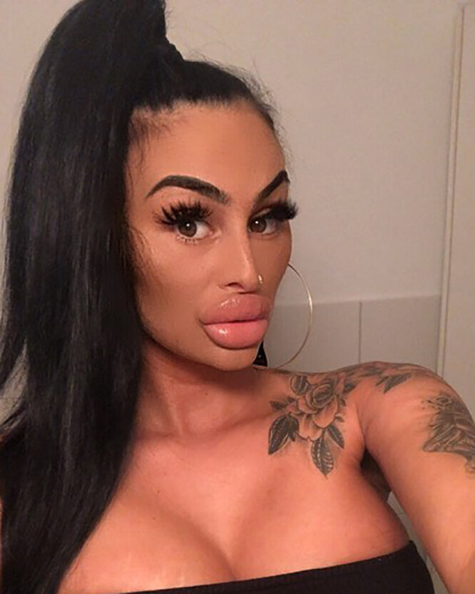 Самые большие губы в мире: 8 девушек, изуродовавших себя филлерами