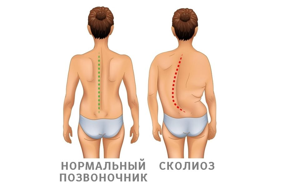 Изгибы позвоночника