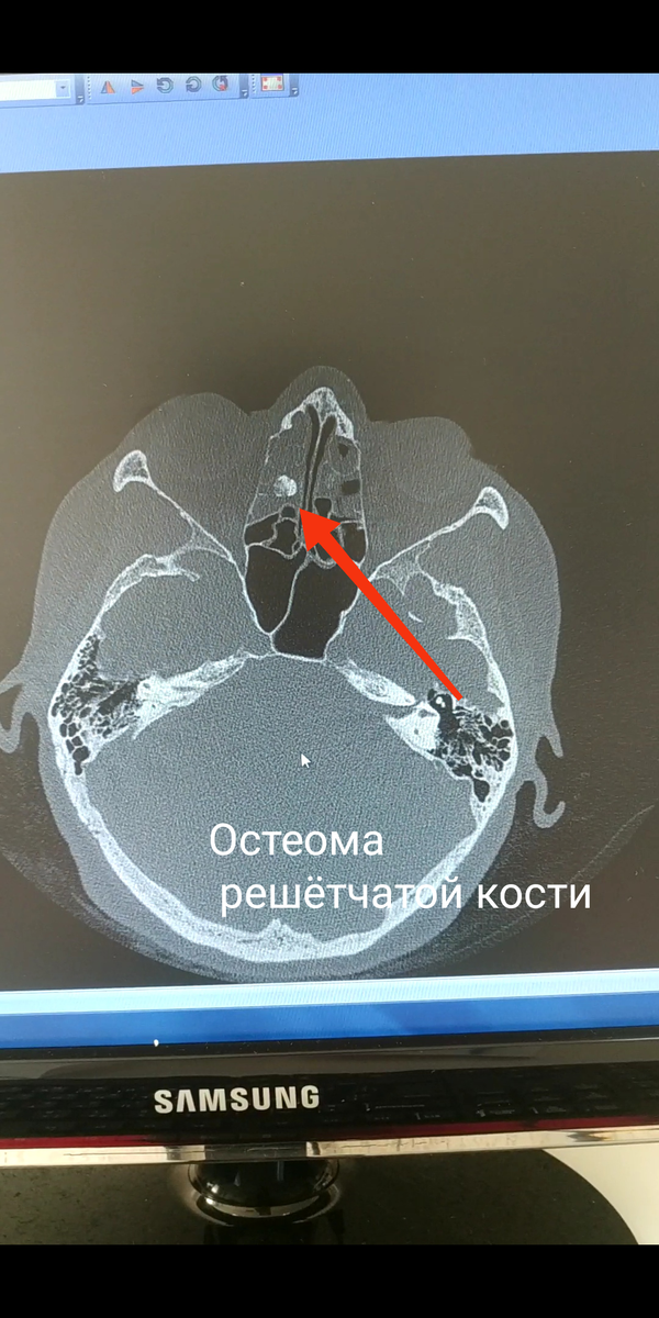 Остеома решётчатой кости