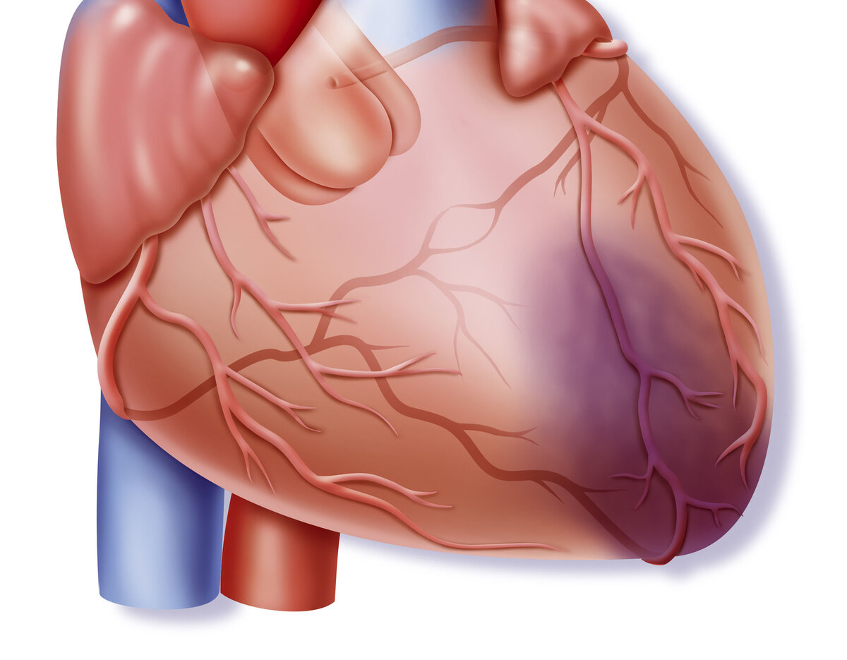 Гейщит инфаркт. Сердце после инфаркта миокарда.