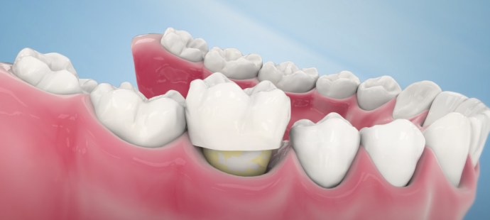 Стачивание зубов под виниры: зачем нужно и как проходит