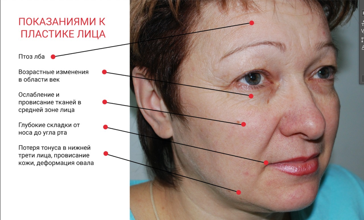 Показания к пластике лица, фото с сайта хирурга Д.Р.Гришкяна, имеются противопоказания, требуется консультация специалиста. 