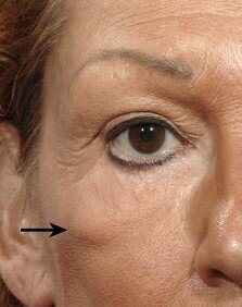 У некоторых суфы проявляются еще в детстве, а у других - с возрастными изменениями. Обычно суфами называют заметные припухлости в области скулы.  Прежде всего появление скулового мешка – это уже патология.  Скуловые отеки обычно проявляются как двойные круги под глазами, которые придают лицу уставший вид.