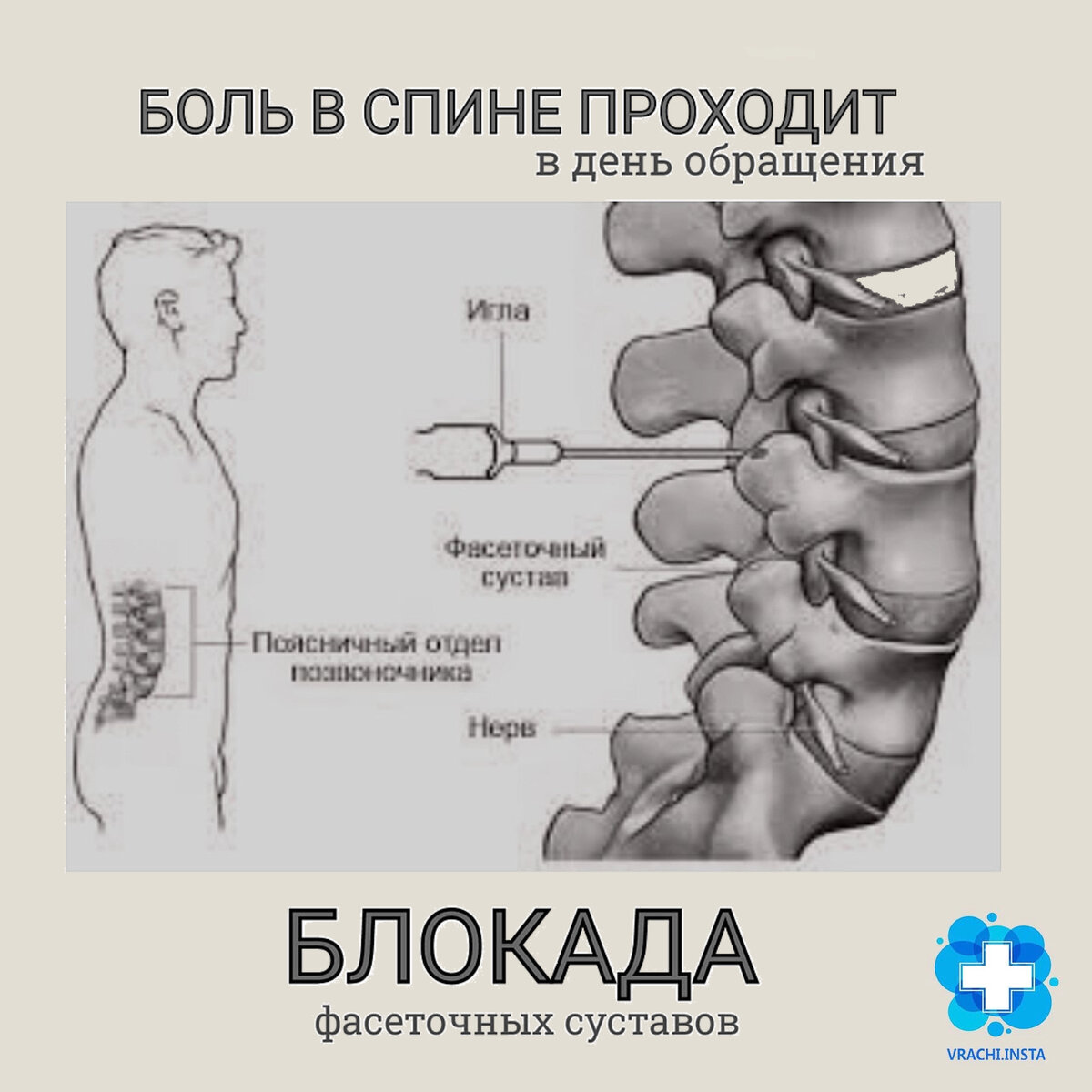 Фасеточные суставы позвоночника картинки