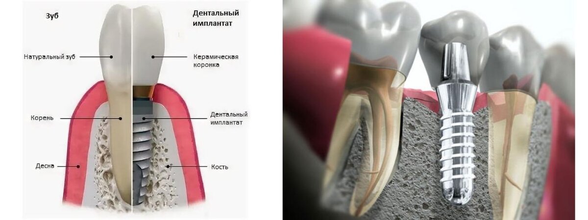 Имплант новокузнецк