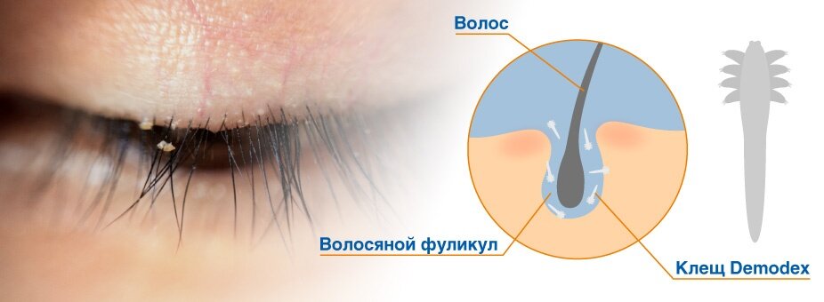 Что такое подкожный клещ. Способы борьбы с демодексом