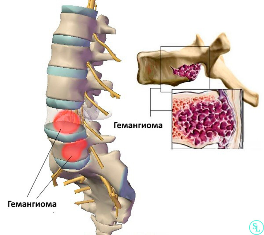 Опухоль в поясничном отделе. Гемангиома позвоночника l5. Гемангиома тела l2 позвоночника. Гемангиома в теле позвонка l2, s1.