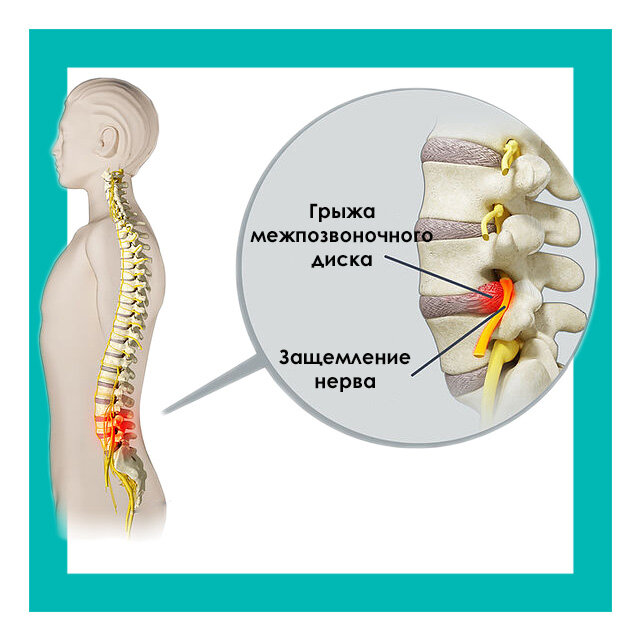Зажат нерв лечение. Защемление нерва в пояснице. Защемило нерв в позвоночнике. Зазимоннин неова в позвоночнике. Нервы в поясни ном отделе.