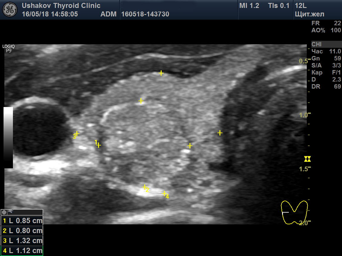 Зачем делать УЗИ щитовидной у обычного 