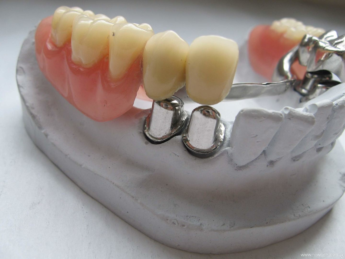 Кламмеры круглые проволочные для фиксации зубных протезов в полости рта 