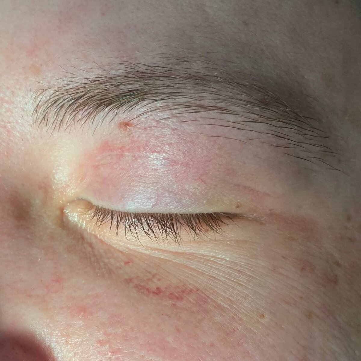 Вид рубца на 12 день после операции 