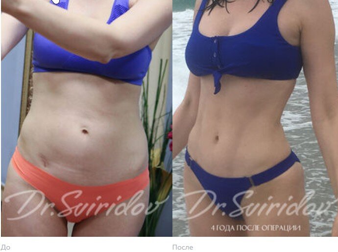 Результаты до и после липосакции
