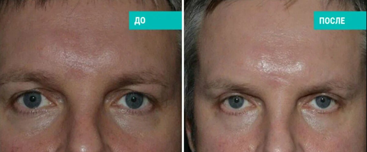 Мужская блефаропластика фото до и после. Фото с сайта Д.Р. Гришкяна. Имеются противопоказания, требуется консультация специалиста