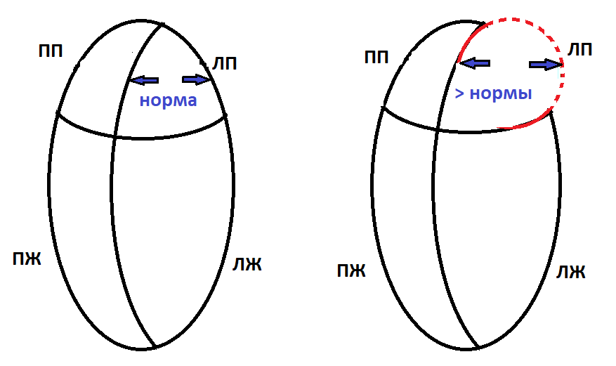 Рисунок слева отражает норму, справа - патологию. ПП - правое предсердие; ЛП - левое предсердие; ПЖ - правый желудочек; ЛЖ - левый желудочек