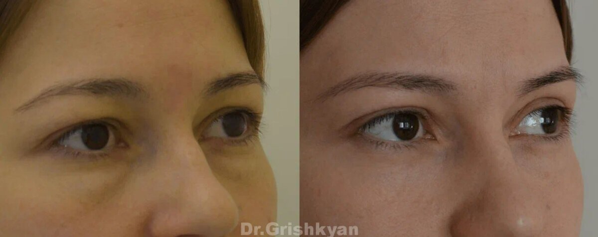 Жиросохраняющая блефаропластика фото до и после. Фото с сайта Д.Р. Гришкяна. Имеются противопоказания, требуется консультация специалиста