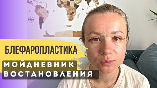 Восстановление после Блефаропластики. Итог после 9 месяцев