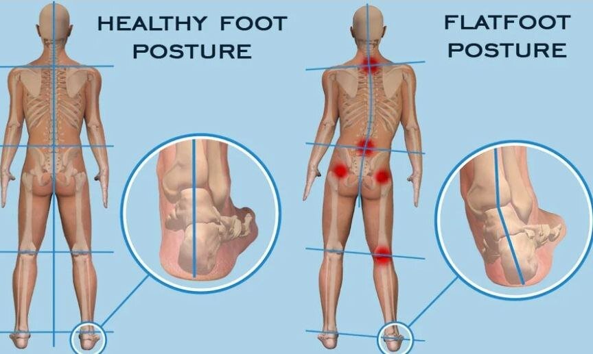 Влияние плоскостопия на суставы и позвоночник