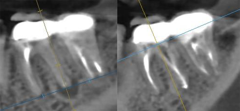 Лечение периодонтита до (слева) и после (справа)