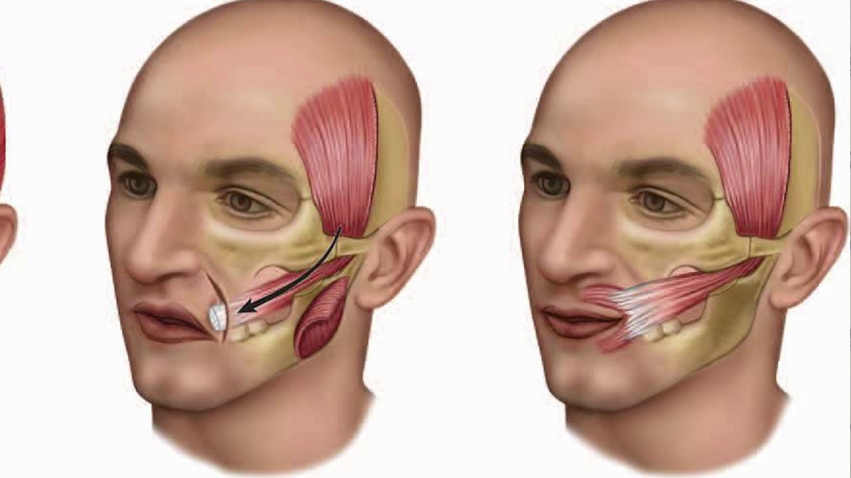 Спазм нижней челюсти. Сухожилие височной мышцы. Атрофия жевательных мышц. Сухожилия на лице. Щечная и жевательная мышца.