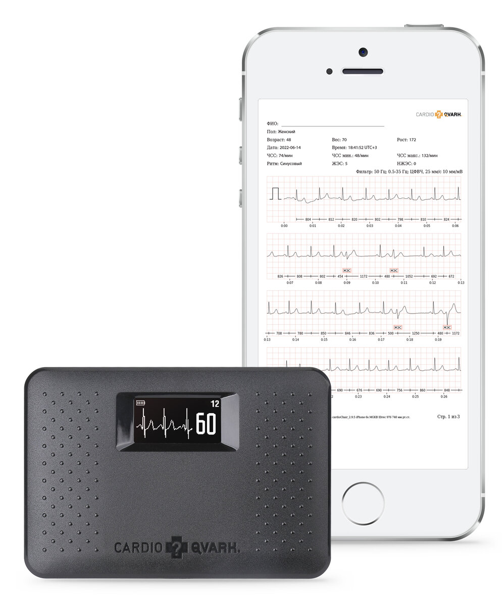 КардиоКАРТА. На 1 минутной записи зарегистрировано 5 шт. ЖЭС. 