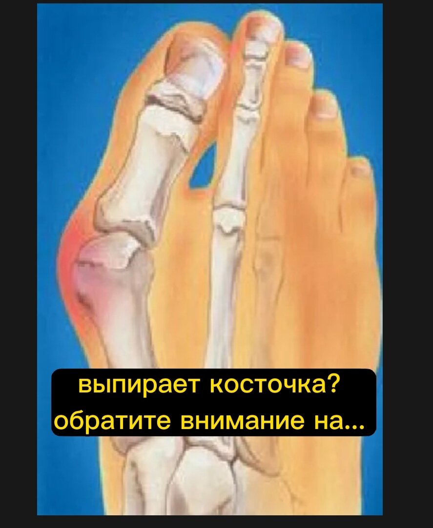 Выпирает косточка на ноге? | Ролан Сэнсэй - Психология самоисцеления ...