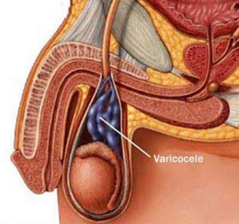 Варикоцеле и его влияние на фертильность