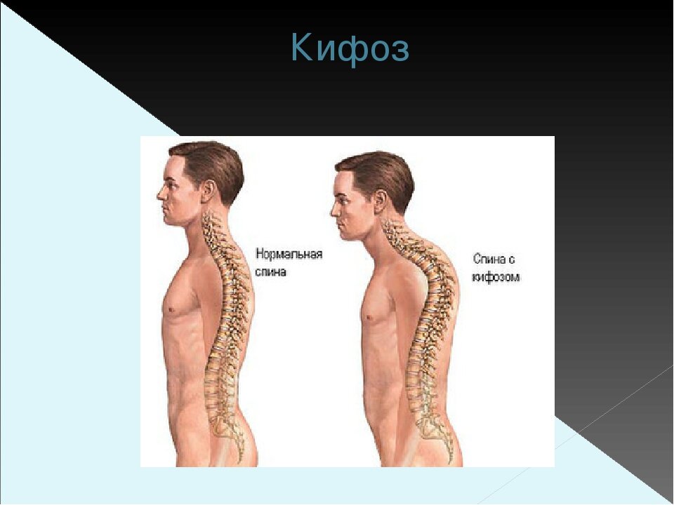 Болезнь шейермана мау что. Болезнь спины Шейермана-МАУ. Кифосколиоз (болезнь Шейермана-МАУ).