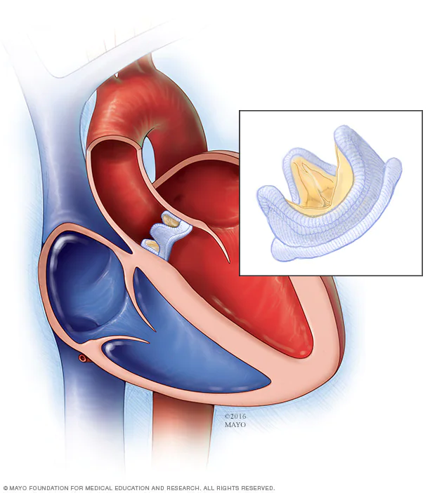 Клапан операция. Аортальный клапан сердца операция. Протез трикуспидального клапана. Протез митрального клапана.