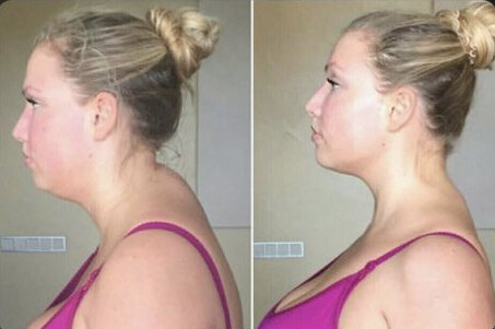 Девушка до/после работы с осанкой.