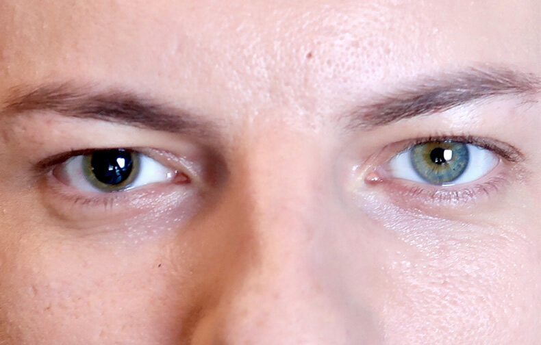 Анизокория