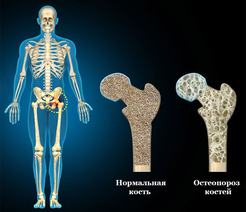 Остеопороз наглядно. Источник: clcl.ru