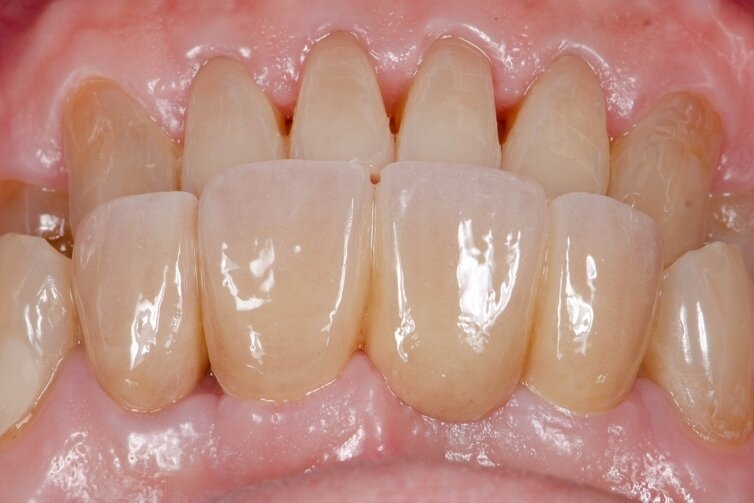 Тетрациклиновые зубы: особенности восстановления