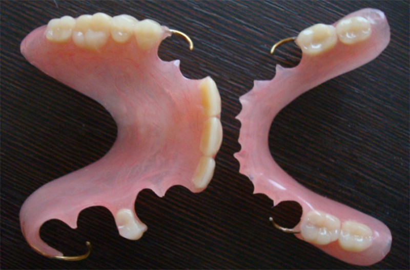 Какие зубные протезы лучше при отсутствии зубов. Частичный съемный протез Flexi n512. Пластиночный частичносъмный протез. Частичный съемный пластиночный протез на нижнюю челюсть. Частичный съемный пластинчатый протез (1-3 зуба).