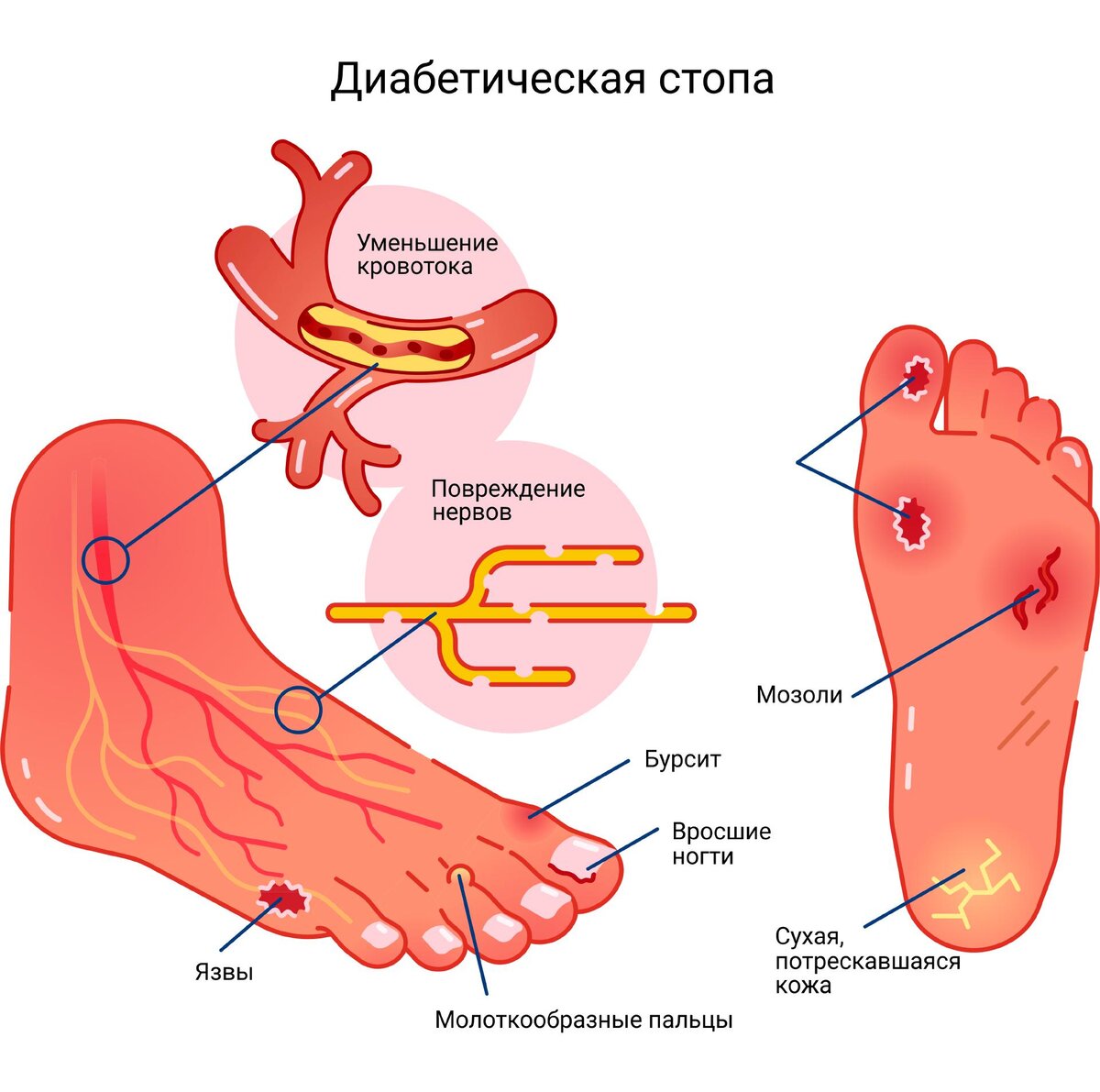 Стопы ног при сахарном диабете. Диабетическая стопа язва.