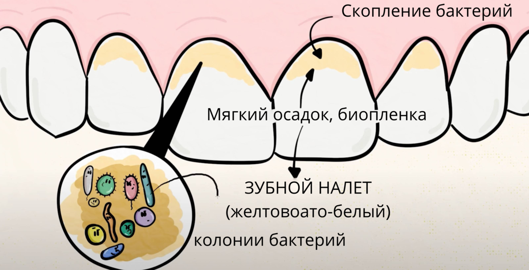 Удаление мягкого зубного налета. Пришеечный зубной налет.