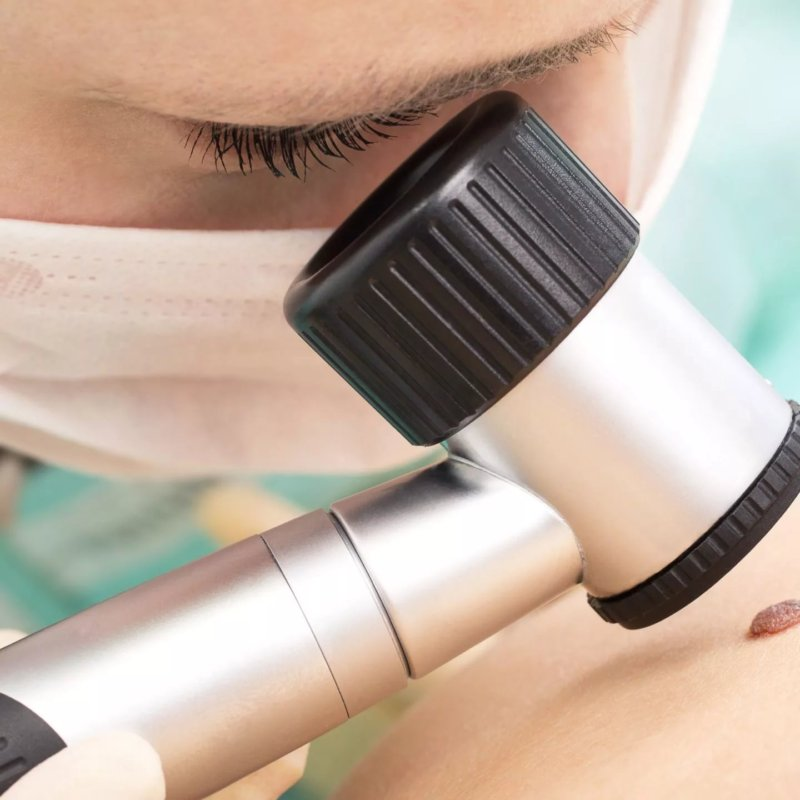 Дермотоскоп позволяет увидеть родинку под увеличением в 20 раз. Фотография с сайта igis.ru