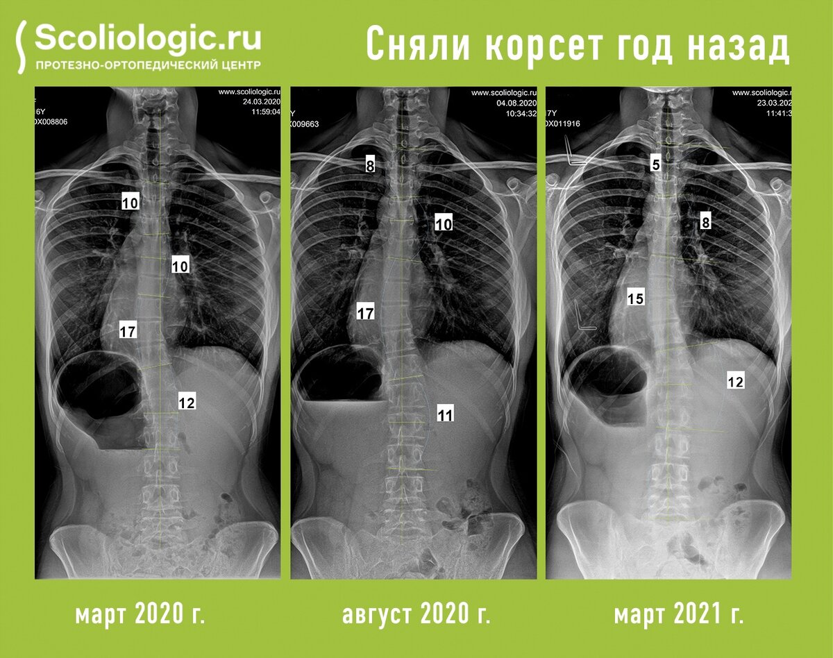 Корсет шрот