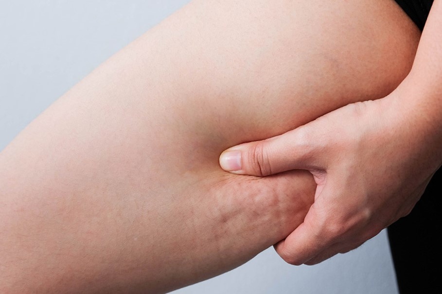 Наш главный враг - целлюлит.