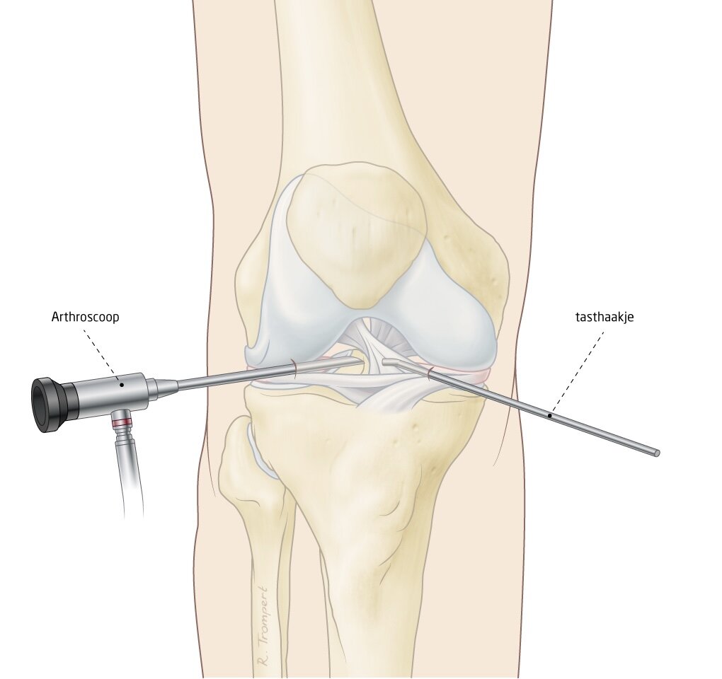 Артроскопия коленного сустава